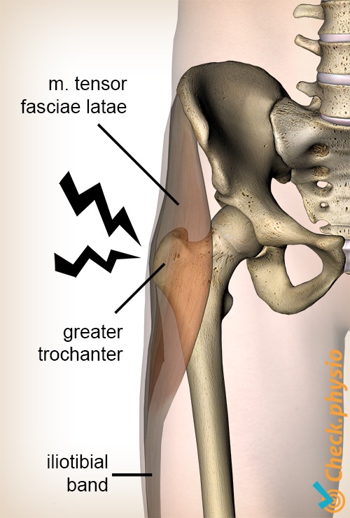 hip greater trochanter pain syndrome anatomy tensor fasciae latae iliotibial band