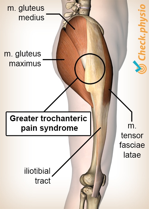 What is Greater Trochanteric Pain Syndrome (GTPS)?