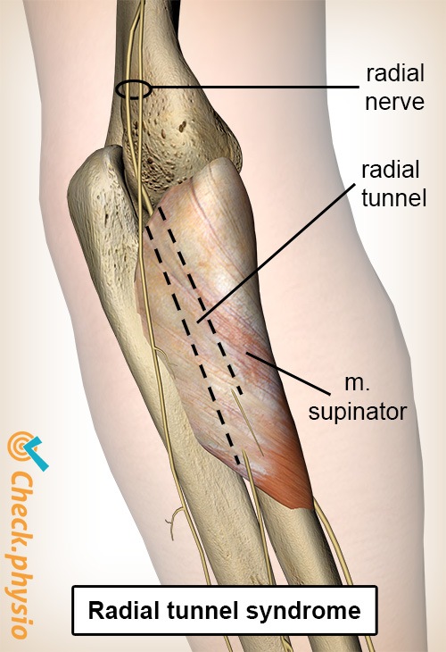 arm radial tunnel radial nerve