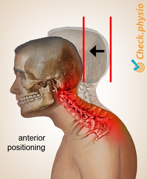 Cervical posture syndrome