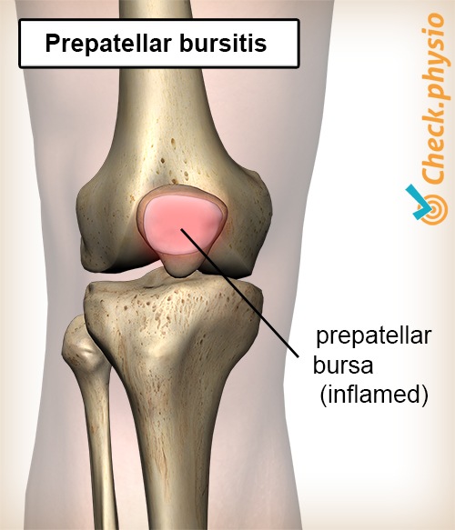knee prepatellar bursitis inflamed bursa knee cap patella