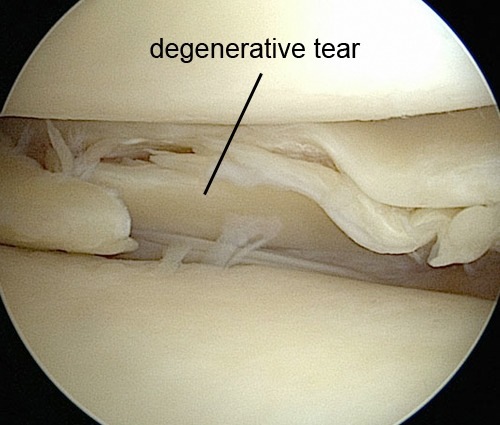 knee meniscus degeneration degenerative