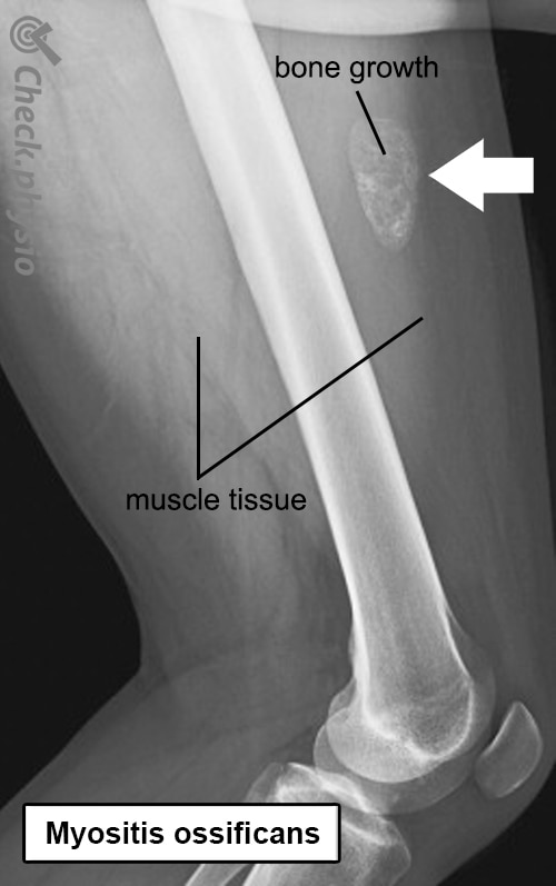 myositis ossifcans x-ray anatomy