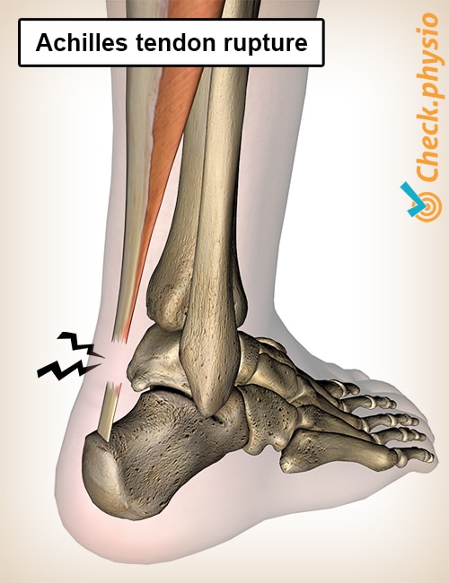 Achilles tendon rupture