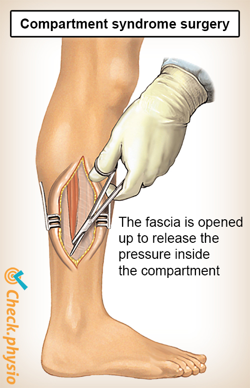 Compartment Syndrome Of The Lower Leg Physio Check