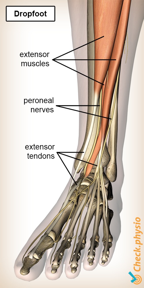 lower leg drop foot peroneal nerves foot extensors muscles tendons