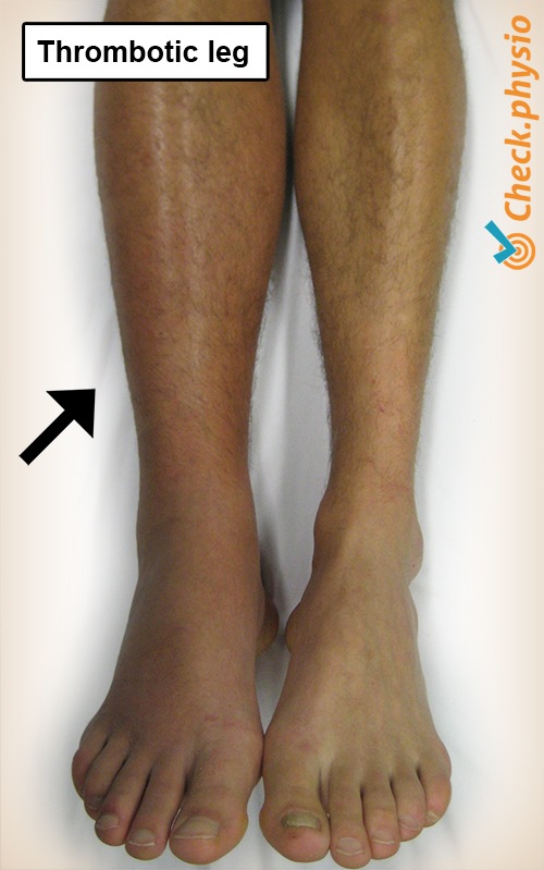lower leg thrombotic leg thrombosis swelling