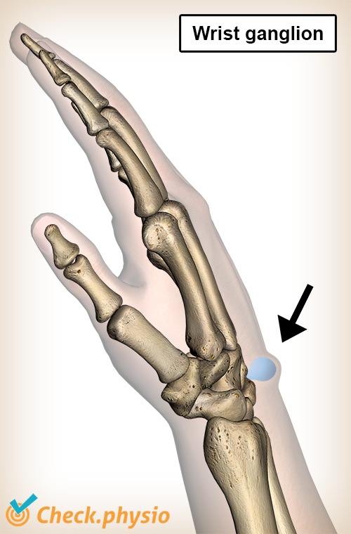 wrist ganglion swelling anatomy mucoid cyst