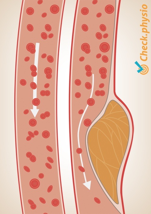 arteriosclerosis artery