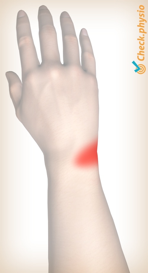 wrist TFCC pain location