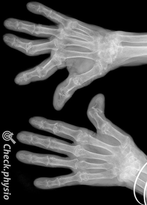 rheumatoid arthritis x-ray