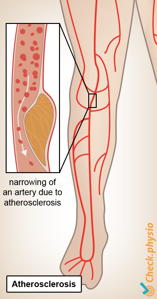 leg shop window legs intermittend claudication plaque formation