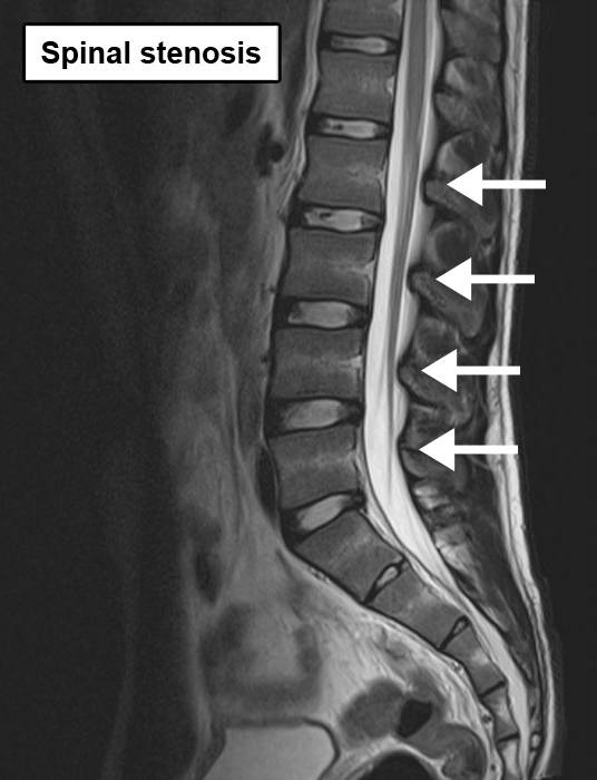 back lumbar spine mri spinal canal stenosis