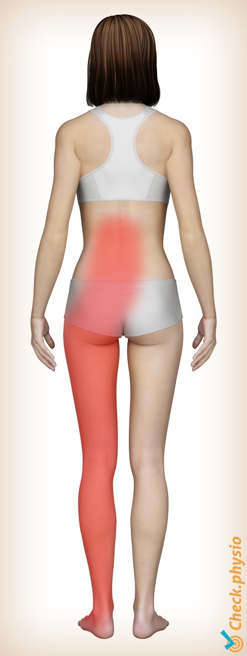 back lumbosacral radicular syndrome hernia pain location