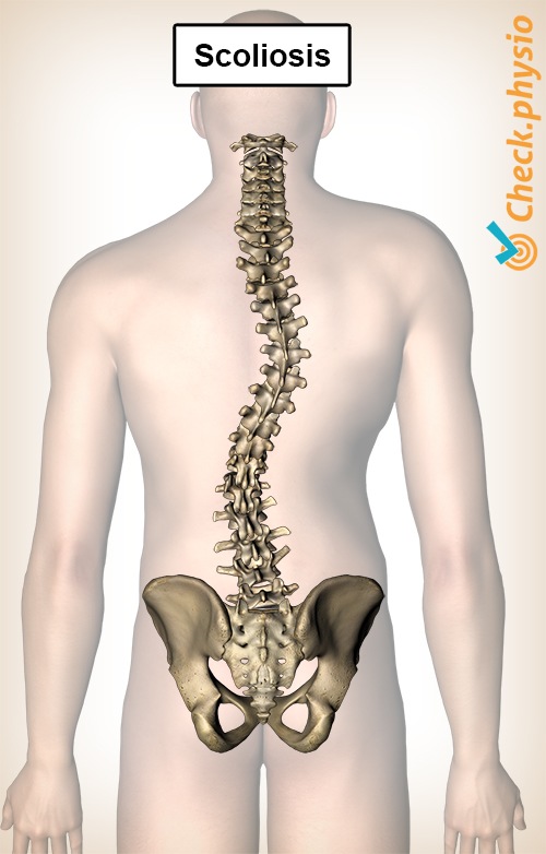 back scoliosis curvature spine spinal column