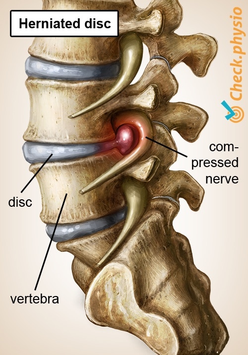 Muscle injury of the upper back