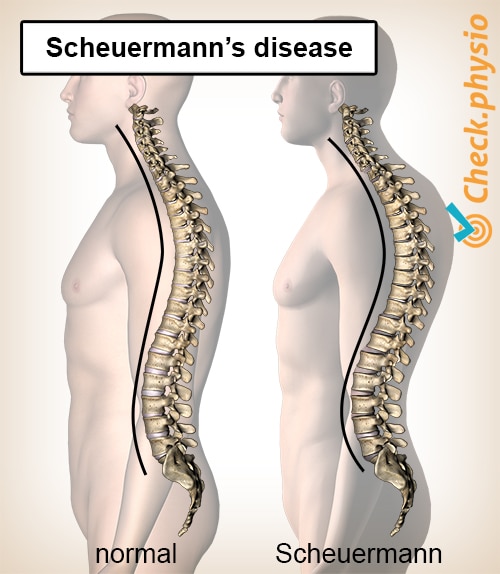 back Scheuermanns disease posture spine spinal column convex kyphosis