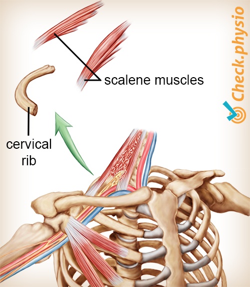 shoulder arm hand thoracic outlet syndrome cervical rib