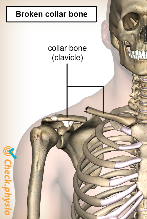shoulder clavicula fracture broken collar bone