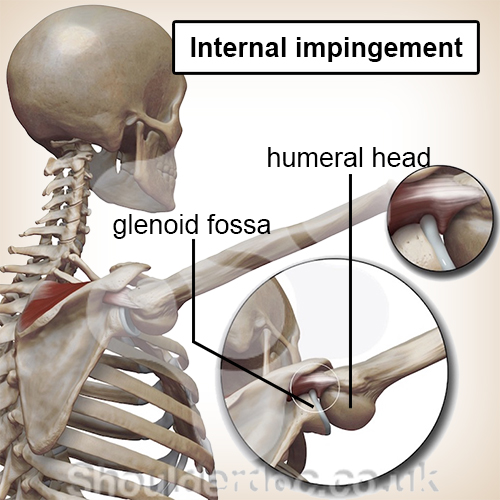 shoulder internal impingement humeral head glenoid fossa socket