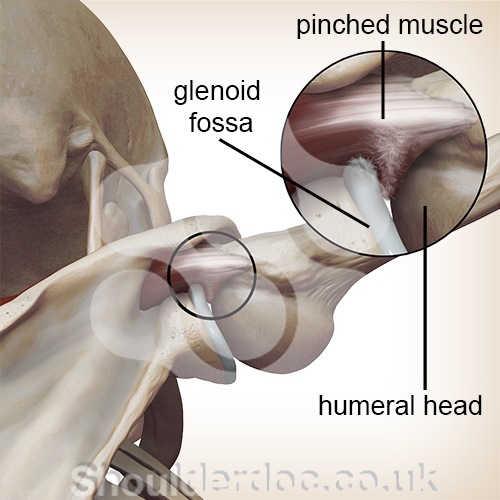 shoulder internal impingement humeral head glenoid fossa socket zoom