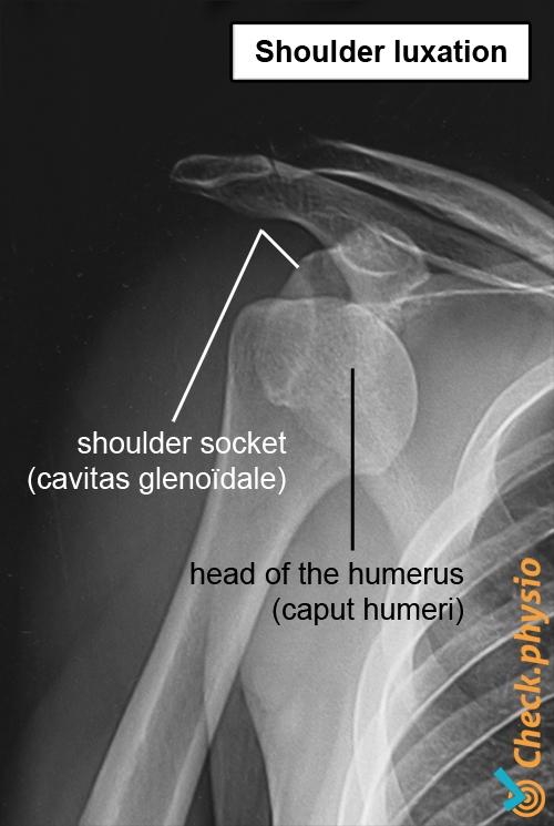shoulder x-ray luxation dislocation