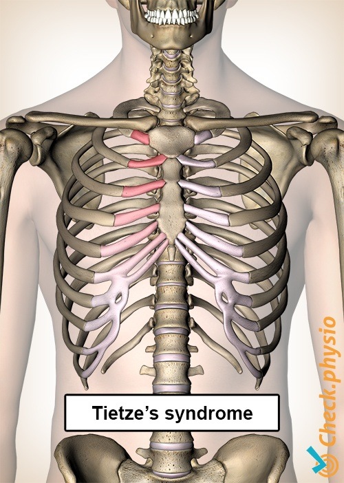 tietzes syndrome ribs pain chest sternum