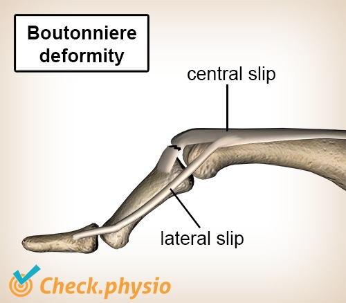 finger boutonniere deformity extensor tendon lateral central slip