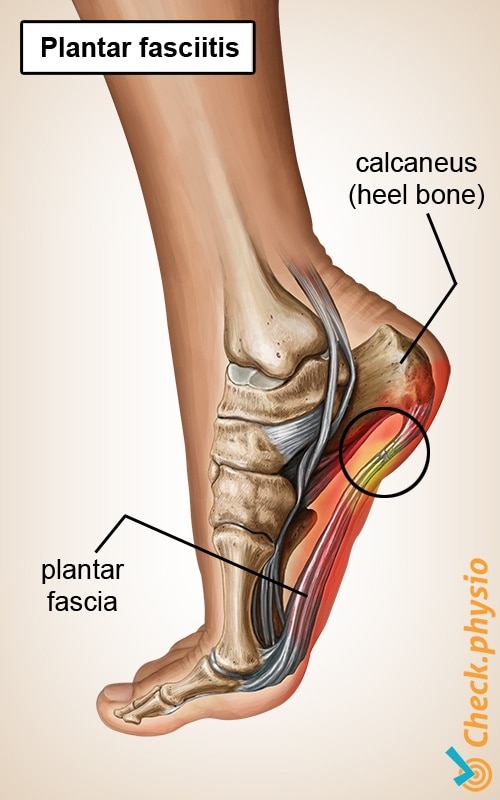 Inferior heel pain - ScienceDirect