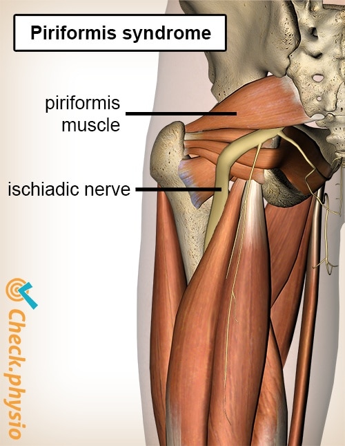 Piriformis Syndrome My MSK Clinic Burnley Manchester