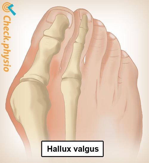 foot hallux valgus anatomy