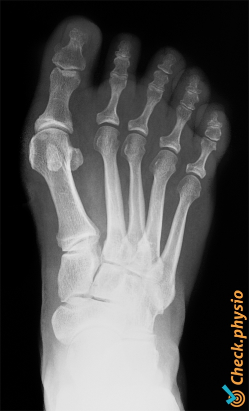 foot hallux valgus x-ray