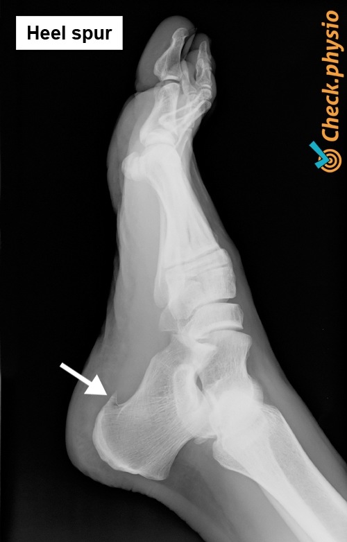foot heel spur x-ray