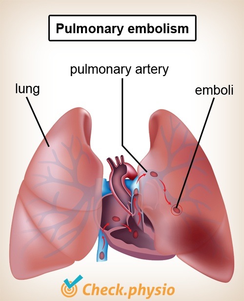 chest lungs pulmonary embolism heart artery