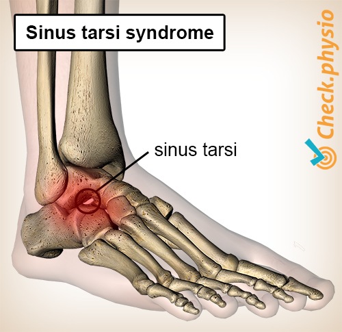 foot sinus tarsi syndrome tunnel