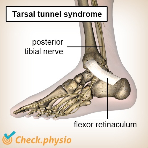foot tarsal tunnel syndrome posterior tibial nerve flexor retinaculum