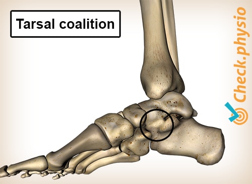 foot tarsal coalition medial inside