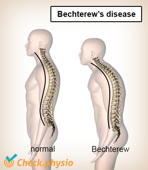 Bechterews disease kyphosis convex back