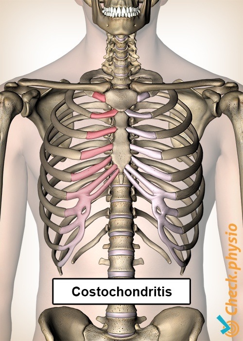 costochondritis ribs pain chest sternum