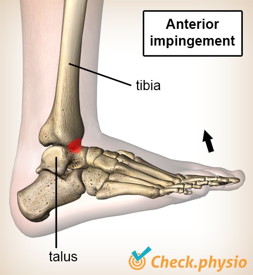 ankle anterior impingement dorsal flexion