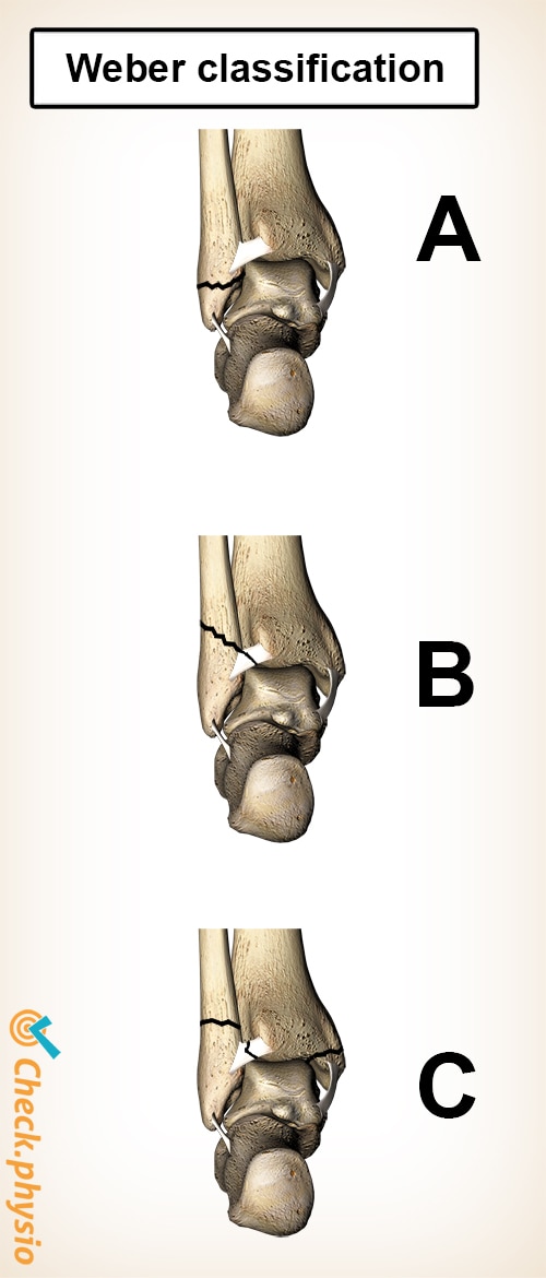 Ankle fracture