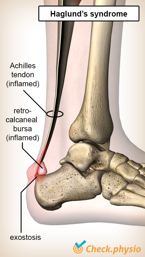 ankle haglund syndrome achilles tendon retrocalcaneal bursa heel bone calcaneus