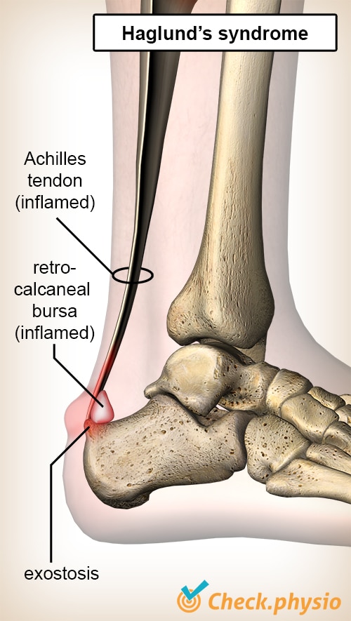 Plantar Fasciitis Stretches to Soothe Heel Pain