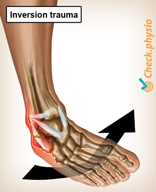 ankle inversion trauma anatomy ankle ligaments