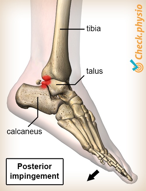 ankle posterior impingement plantar flexion