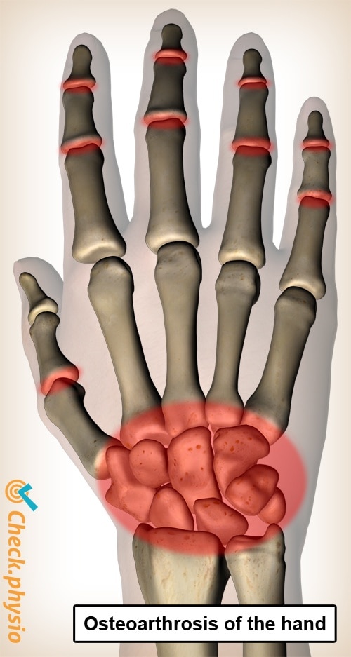 Osteoarthritis Hand