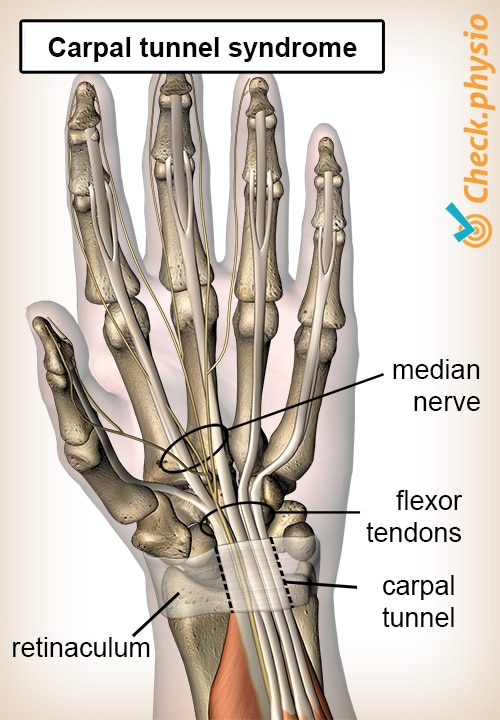 Carpal tunnel syndrome