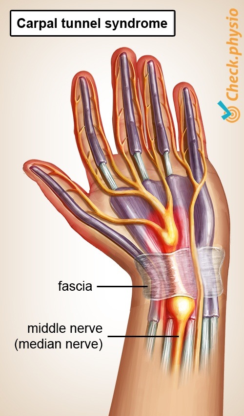 hand carpal tunnel syndrome cts median nerve impingement