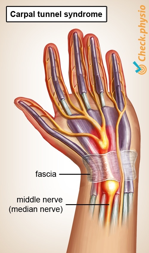 hand carpal tunnel syndrome CTS median nerve impingement