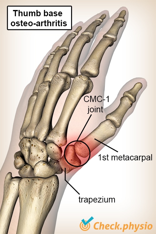 hand thumb base osteoarthritis trapezium bone metacarpal I CMC 1 joint